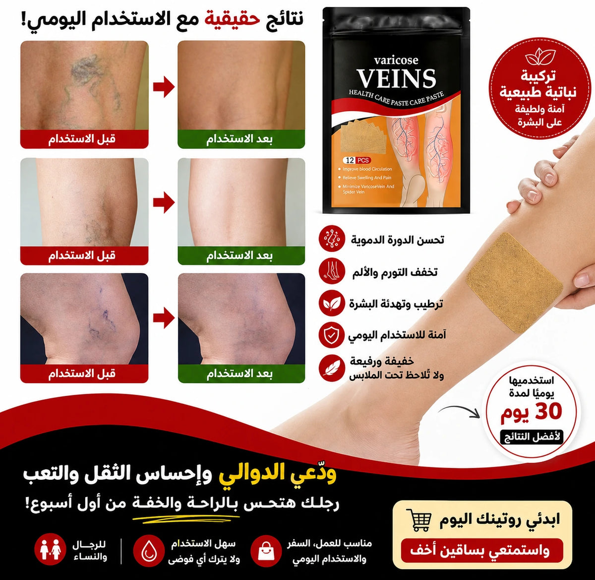 لاصقات الدوالي بتقنية نباتية طبيعية